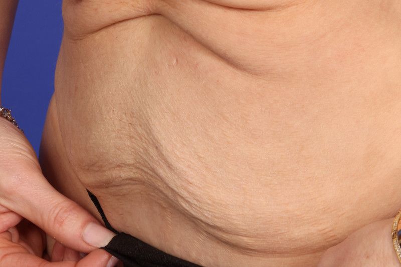 RF Microneedling Before & After Image