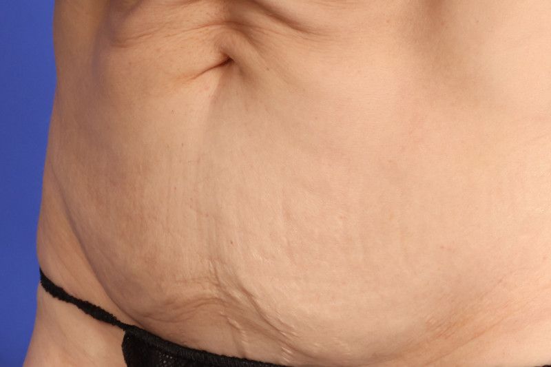RF Microneedling Before & After Image