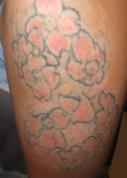 Tattoo Removal Before & After Image