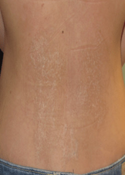 Tattoo Removal Before & After Image