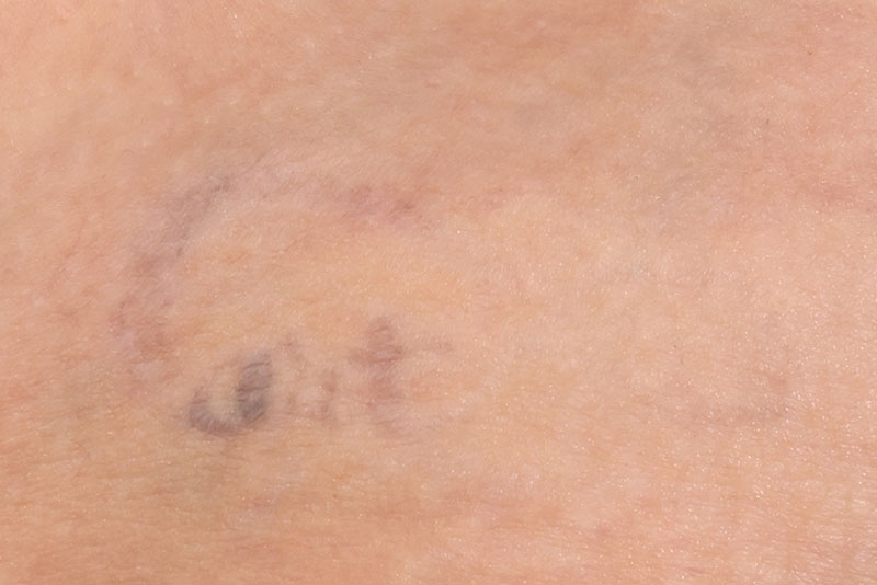 Tattoo Removal Before & After Image